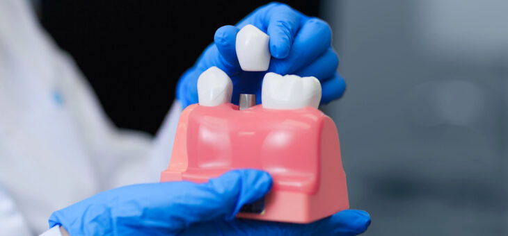 How New Materials Are Redefining the Longevity and Success of Dental Implants