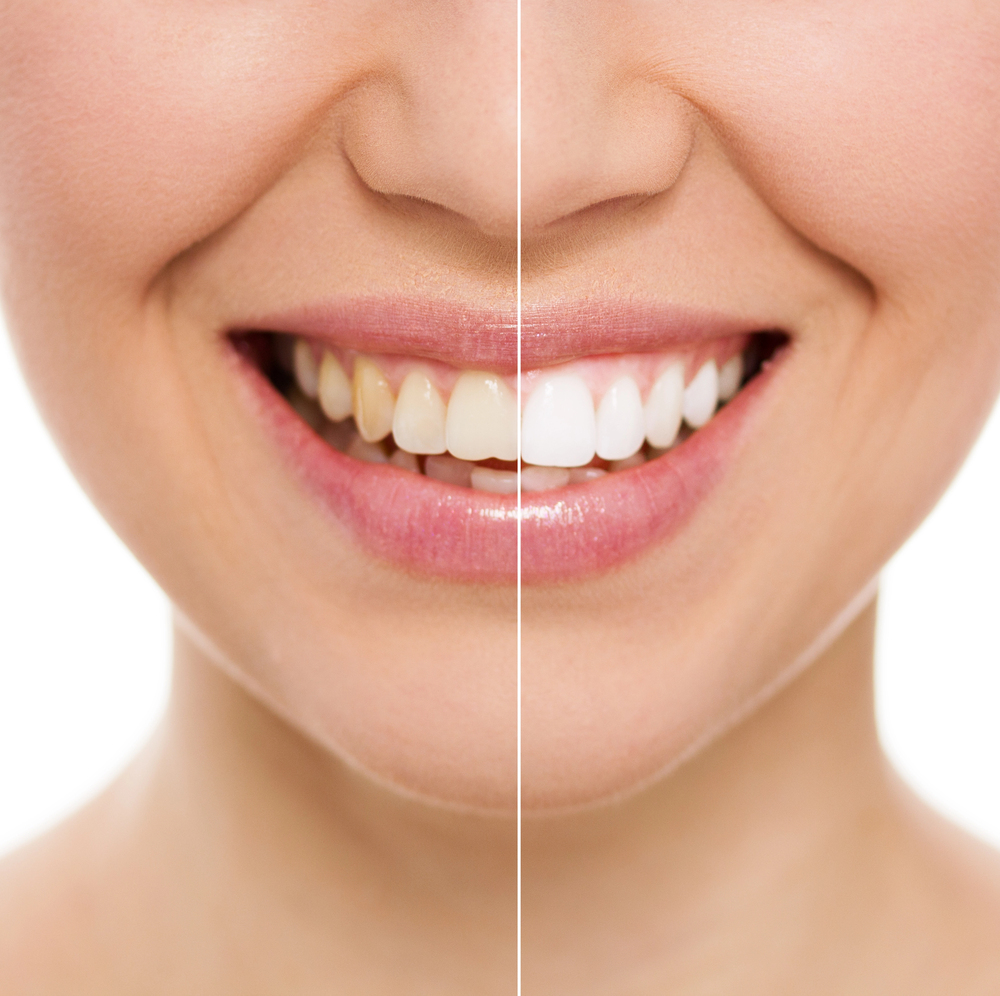 market growth for teeth whitening